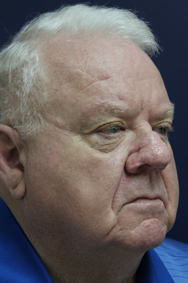 Rhinophyma Surgery Before & After Gallery - Patient 60806982 - Image 4
