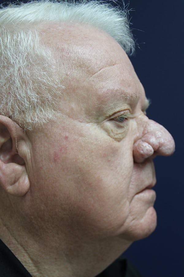 Rhinophyma Surgery Before & After Gallery - Patient 60806982 - Image 5