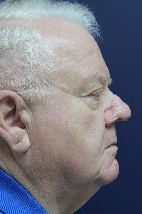 Rhinophyma Surgery Before & After Gallery - Patient 60806982 - Image 6