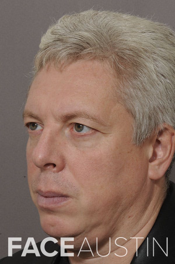 Rhinoplasty Before & After Gallery - Patient 18726391 - Image 1