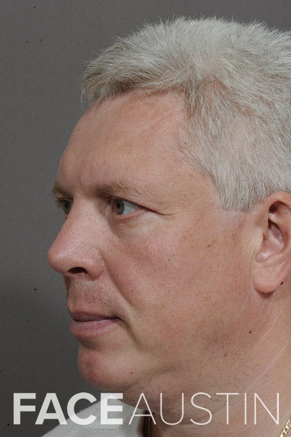 Rhinoplasty Before & After Gallery - Patient 18726391 - Image 2