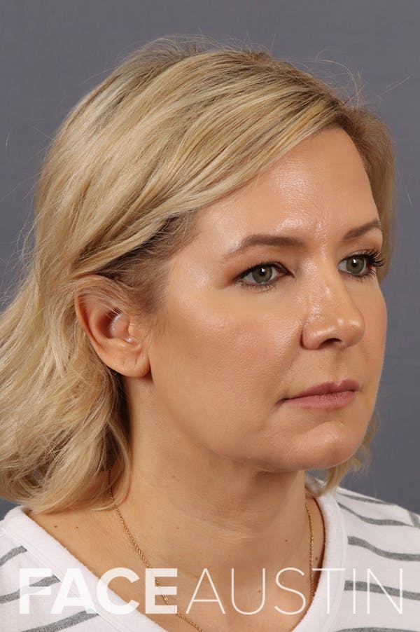 Facelift Before & After Gallery - Patient 172881928 - Image 1