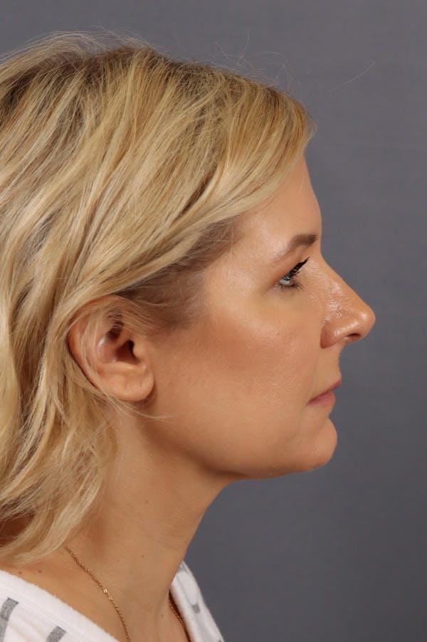 Facelift Before & After Gallery - Patient 172881928 - Image 3