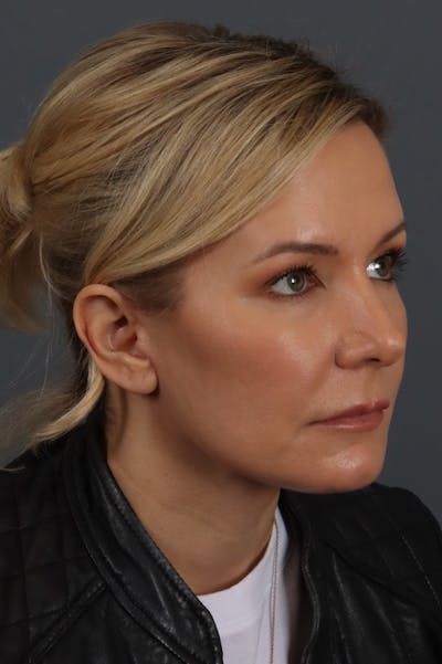 Facelift Before & After Gallery - Patient 172881928 - Image 2