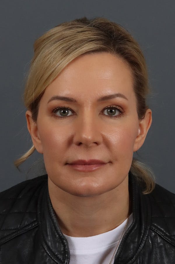 Facelift Before & After Gallery - Patient 172881928 - Image 6