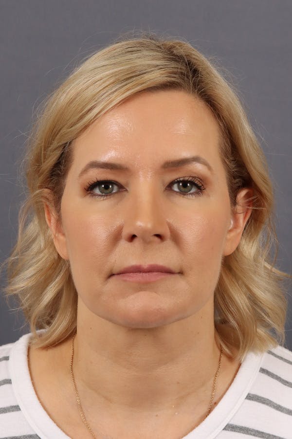 Facelift Before & After Gallery - Patient 172881928 - Image 5