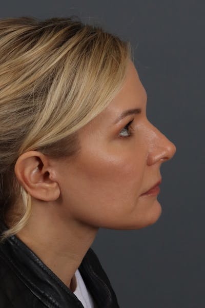 Facelift Before & After Gallery - Patient 172881928 - Image 4