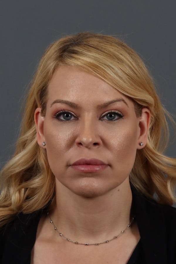 Facelift Before & After Gallery - Patient 172881927 - Image 6