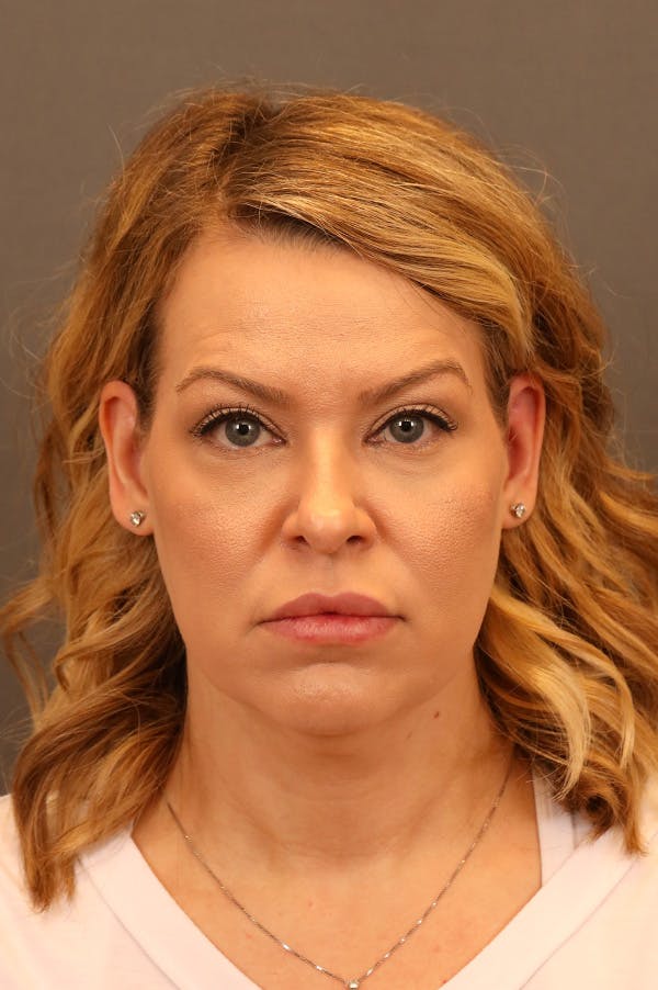 Facelift Before & After Gallery - Patient 172881927 - Image 5