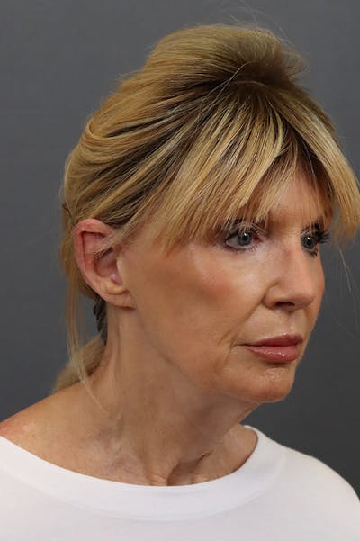 Facelift Before & After Gallery - Patient 172881926 - Image 1