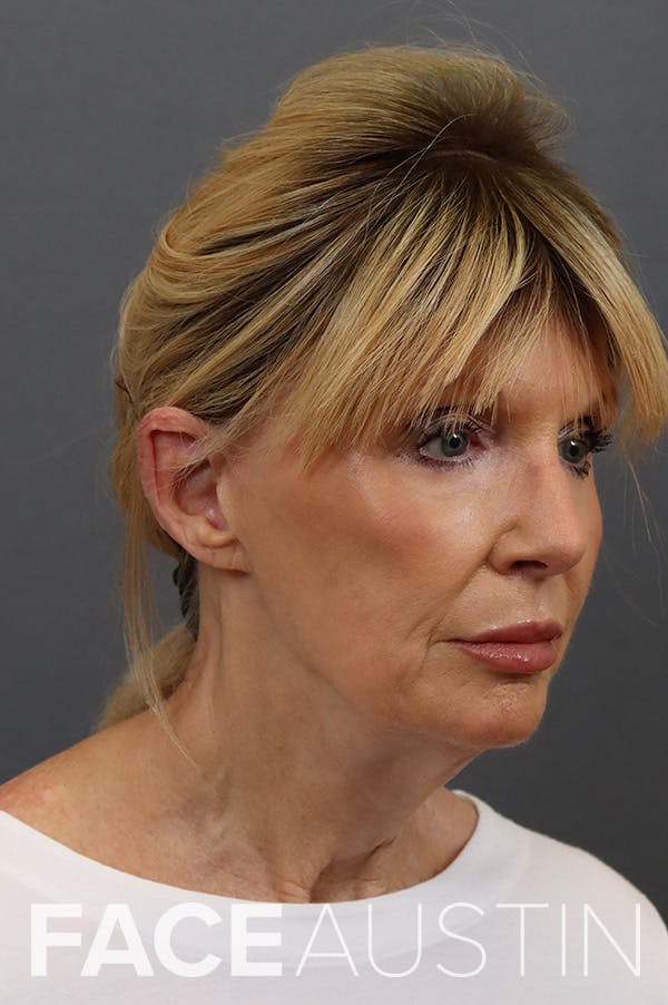 Facelift Before & After Gallery - Patient 172881926 - Image 1