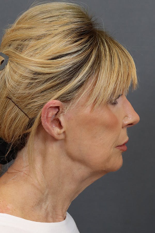 Facelift Before & After Gallery - Patient 172881926 - Image 3