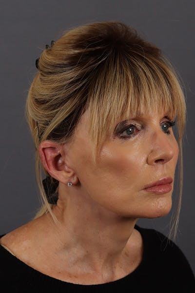 Facelift Before & After Gallery - Patient 172881926 - Image 2