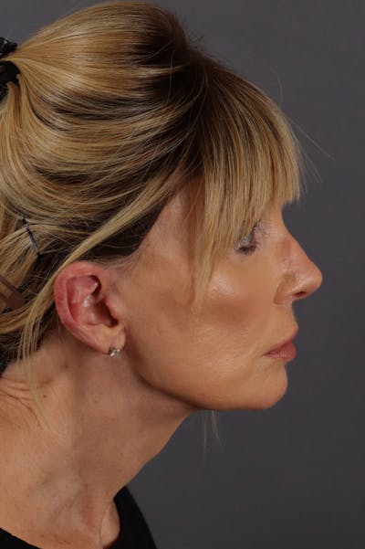 Facelift Before & After Gallery - Patient 172881926 - Image 4