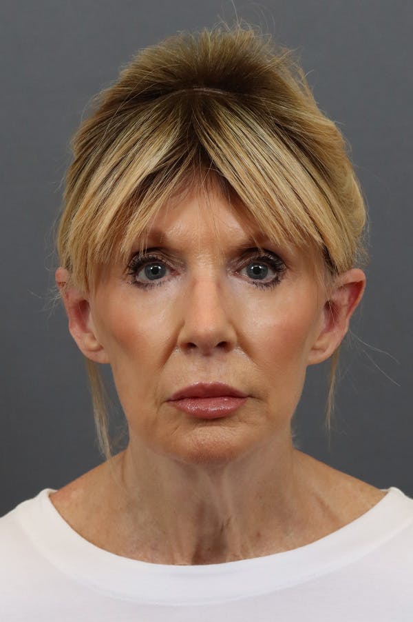 Facelift Before & After Gallery - Patient 172881926 - Image 5