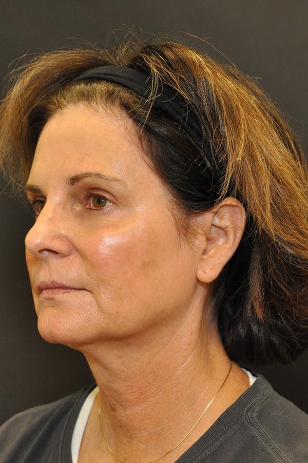 Facelift Before & After Gallery - Patient 172881924 - Image 1