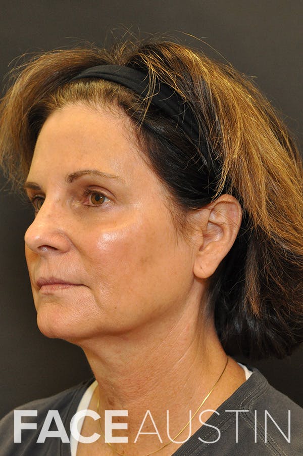 Facelift Before & After Gallery - Patient 172881924 - Image 1