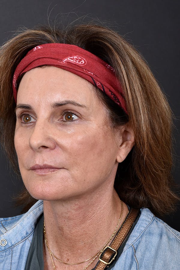 Facelift Before & After Gallery - Patient 172881924 - Image 2