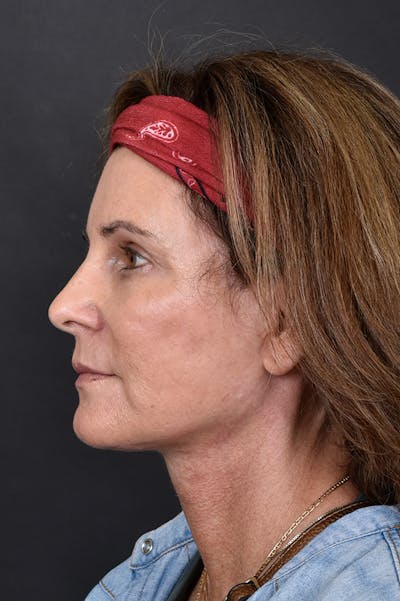 Facelift Before & After Gallery - Patient 172881924 - Image 4
