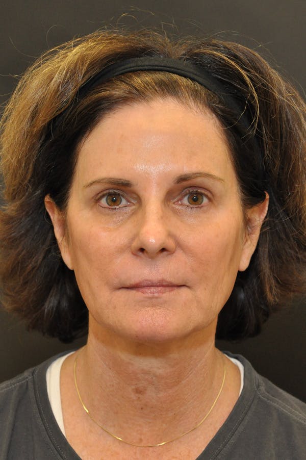 Facelift Before & After Gallery - Patient 172881924 - Image 5