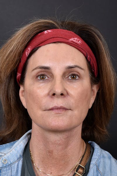 Facelift Before & After Gallery - Patient 172881924 - Image 6