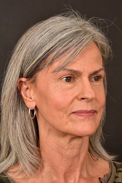 Facelift Before & After Gallery - Patient 172881923 - Image 1