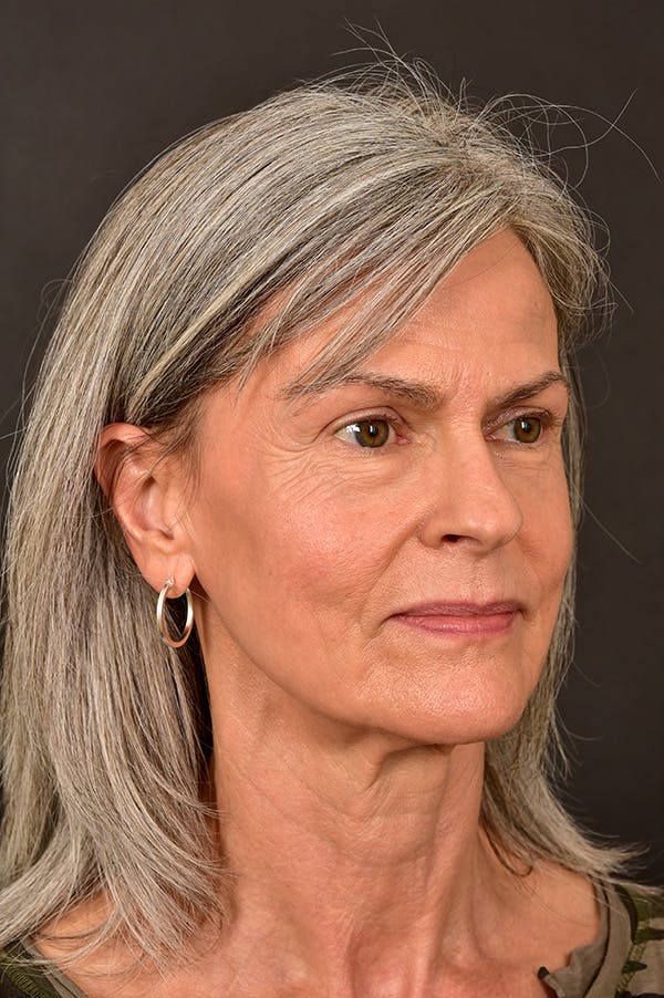 Facelift Before & After Gallery - Patient 172881923 - Image 1
