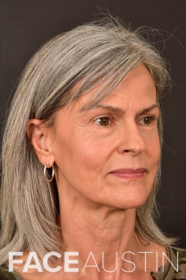 Facelift Before & After Gallery - Patient 172881923 - Image 1