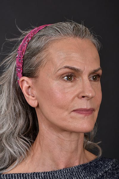 Facelift Before & After Gallery - Patient 172881923 - Image 2