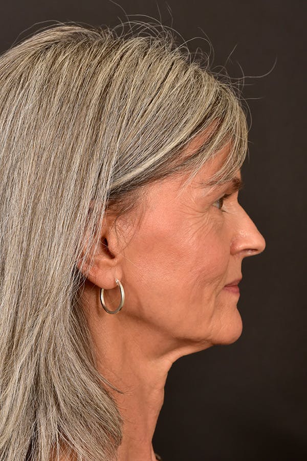 Facelift Before & After Gallery - Patient 172881923 - Image 3