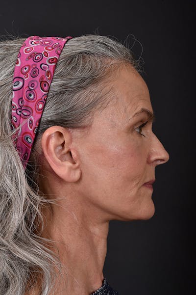 Facelift Before & After Gallery - Patient 172881923 - Image 4