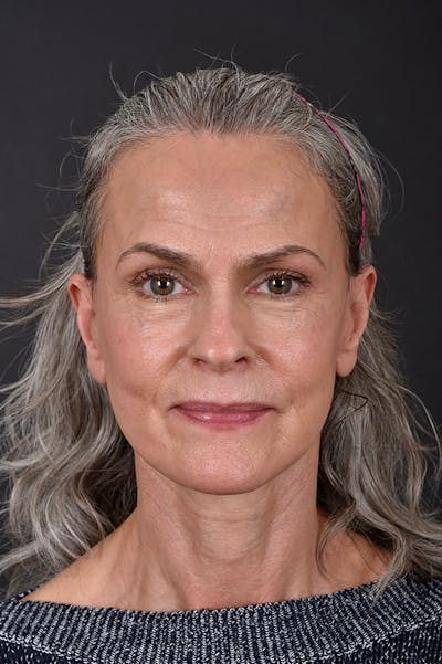 Facelift Before & After Gallery - Patient 172881923 - Image 6