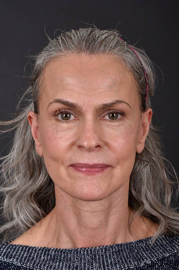 Facelift Before & After Gallery - Patient 172881923 - Image 6