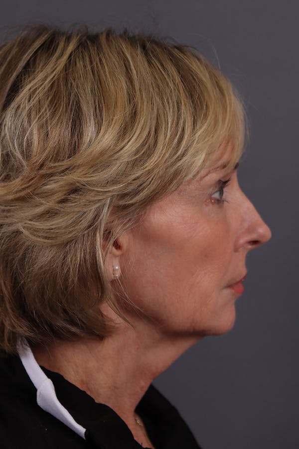 Facelift Before & After Gallery - Patient 172881922 - Image 3