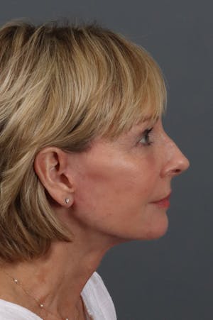 Neck Lift in Austin Before & After Photos