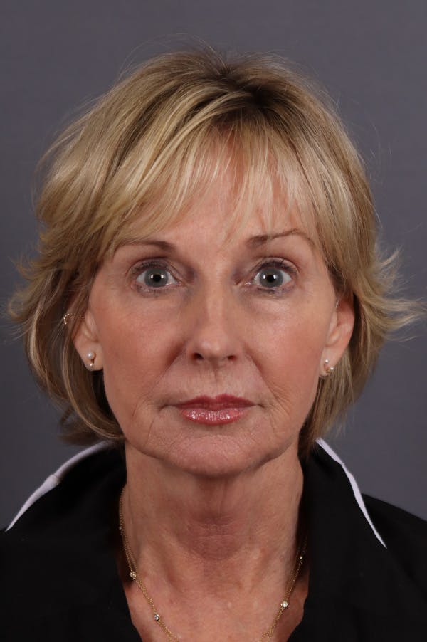 Facelift Before & After Gallery - Patient 172881922 - Image 5