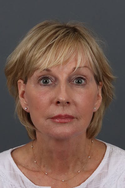 Facelift Before & After Gallery - Patient 172881922 - Image 6