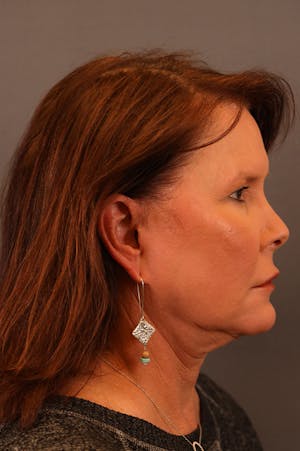 Neck Lift & Facelift female patient