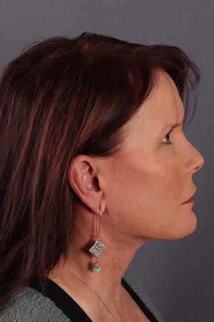 Neck Lift & Facelift female patient