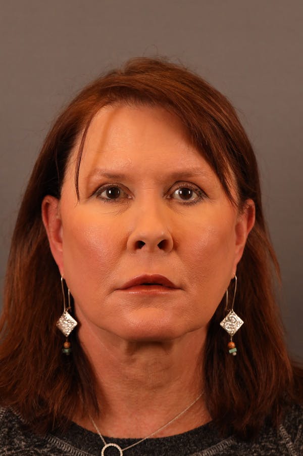Facelift Before & After Gallery - Patient 172881921 - Image 5