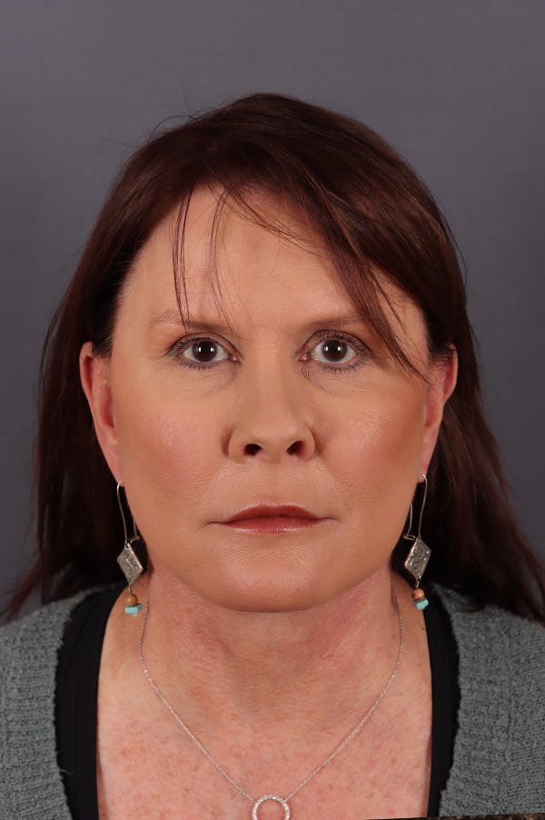Facelift Before & After Gallery - Patient 172881921 - Image 6