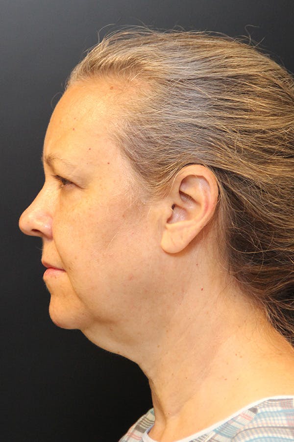 Facelift Before & After Gallery - Patient 172881936 - Image 3