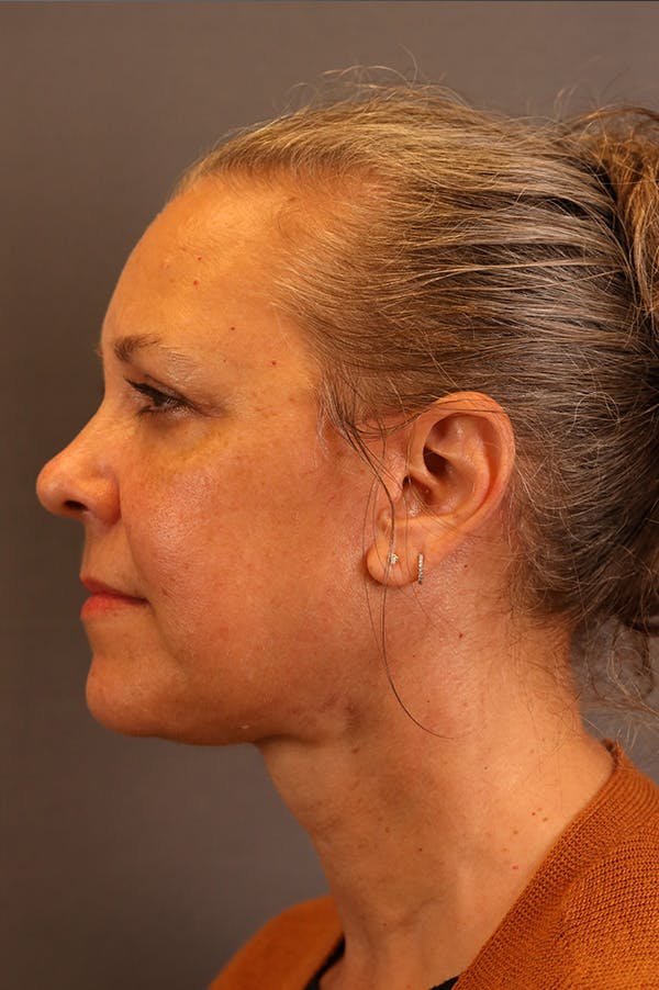 Facelift Before & After Gallery - Patient 172881936 - Image 4