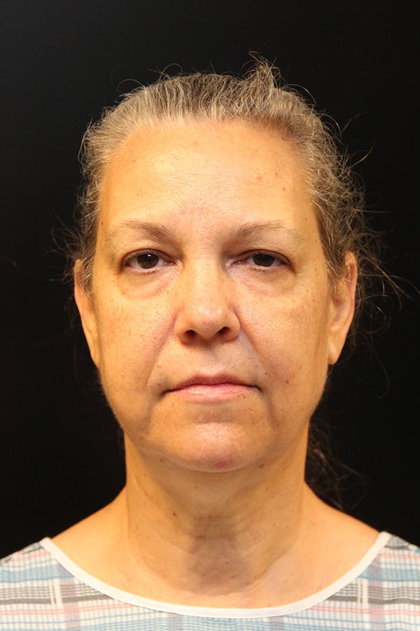 Facelift Before & After Gallery - Patient 172881936 - Image 5