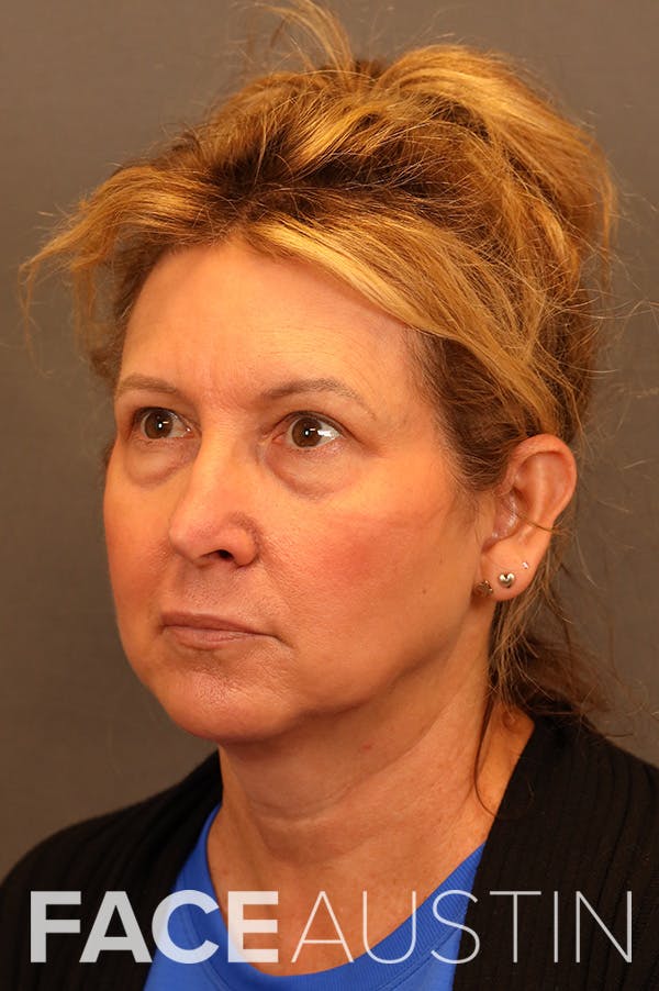 Facelift Before & After Gallery - Patient 172881950 - Image 1