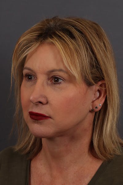 Facelift Before & After Gallery - Patient 172881950 - Image 2