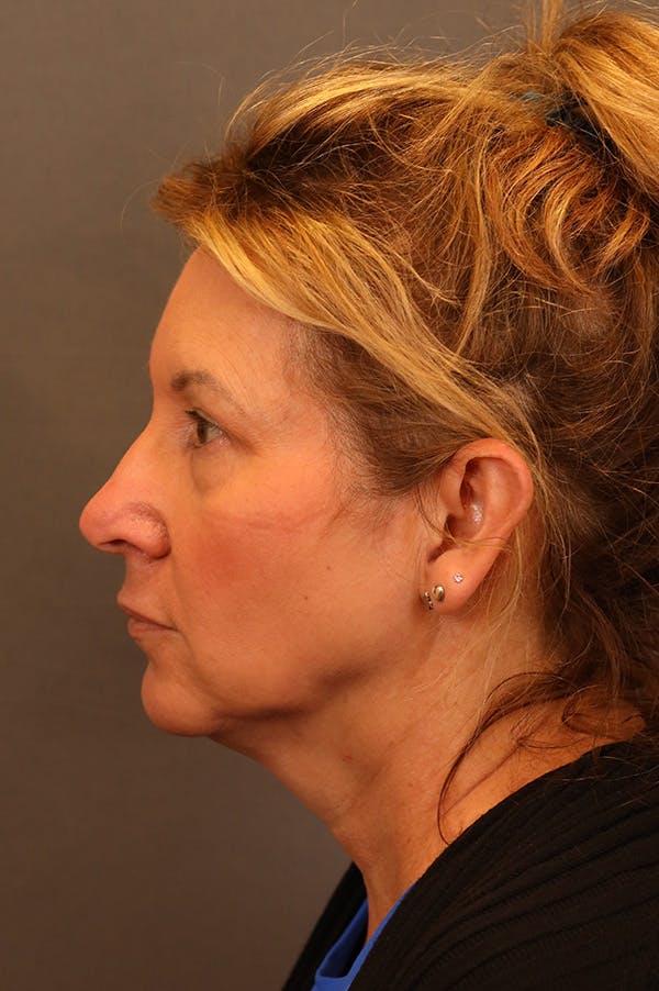 Facelift Before & After Gallery - Patient 172881950 - Image 3