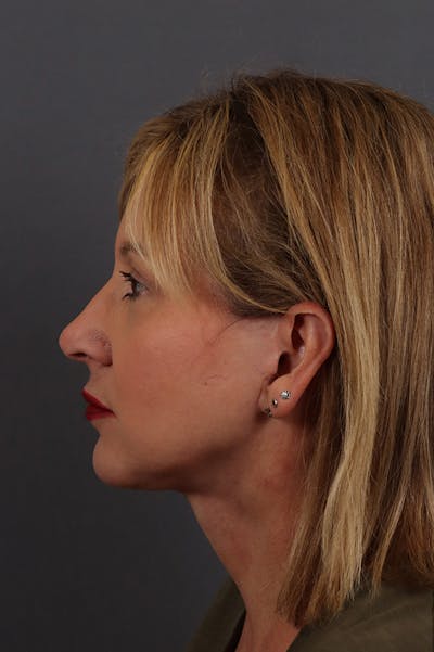 Facelift Before & After Gallery - Patient 172881950 - Image 4