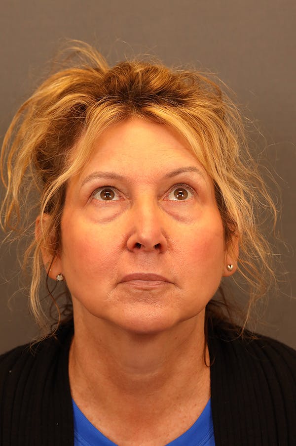 Facelift Before & After Gallery - Patient 172881950 - Image 5
