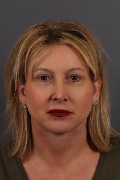 Facelift in Austin Before & After Photo